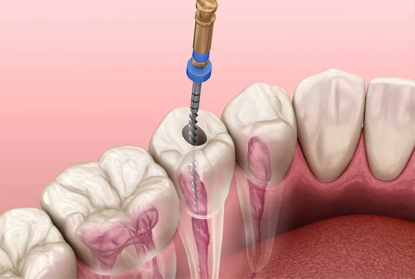 Root Canal Treatment (RCT)
