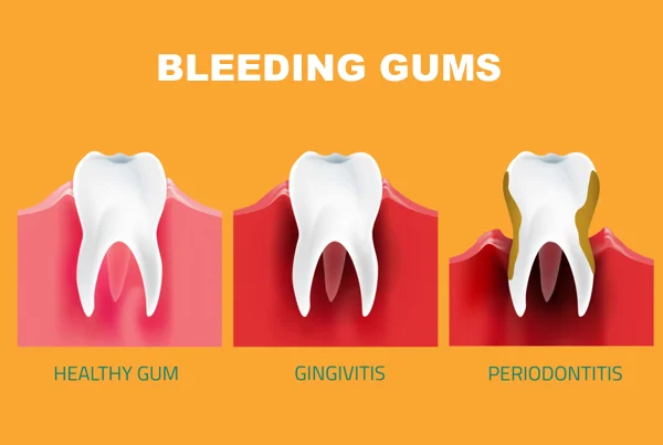 Pyorrhea & Bleeding Gums