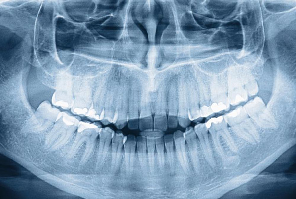 Low Radiation X-Ray