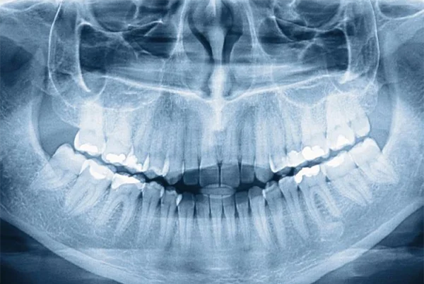 Low Radiation X-Ray