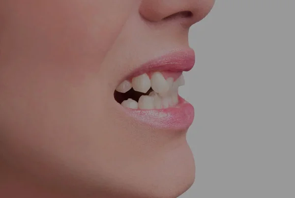 Correction of Irregular Teeth