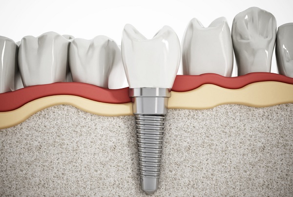 Dental Implant