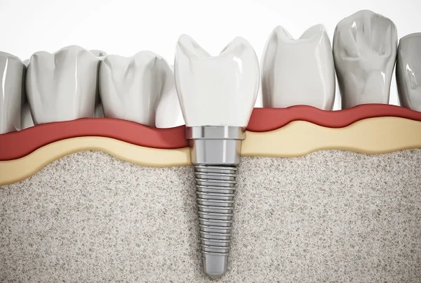 Dental Implant