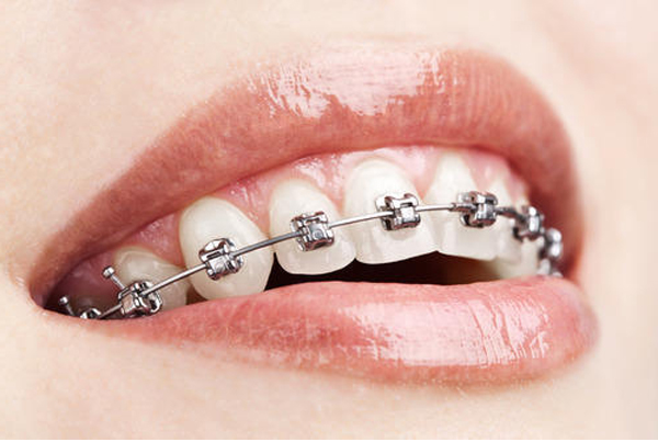 Braces