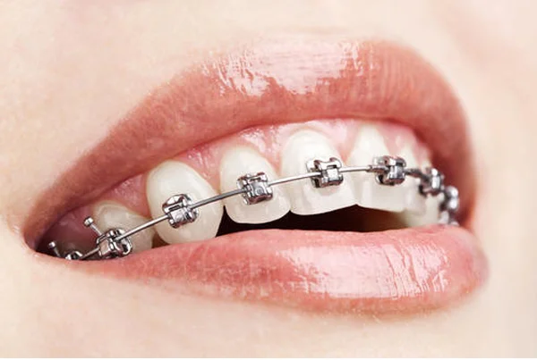 Braces